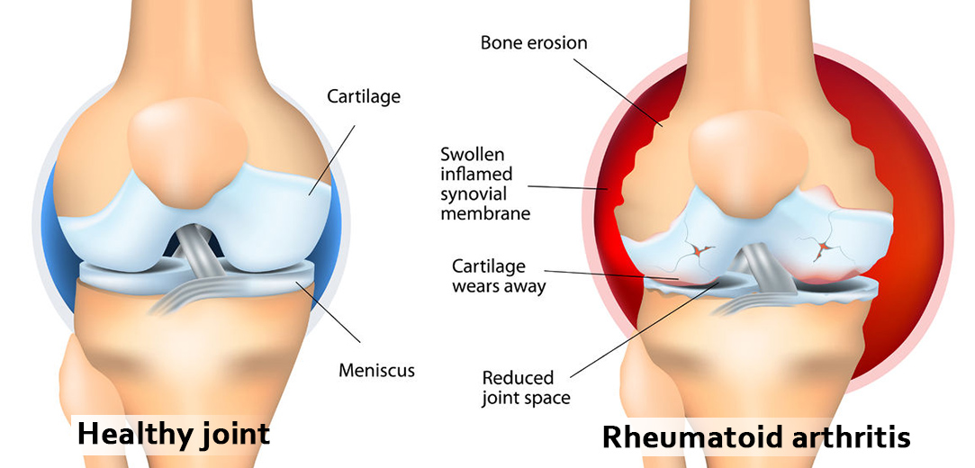 knee_laser_7_1083