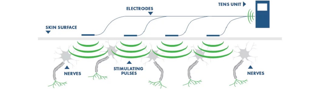 TENS_principles_1083