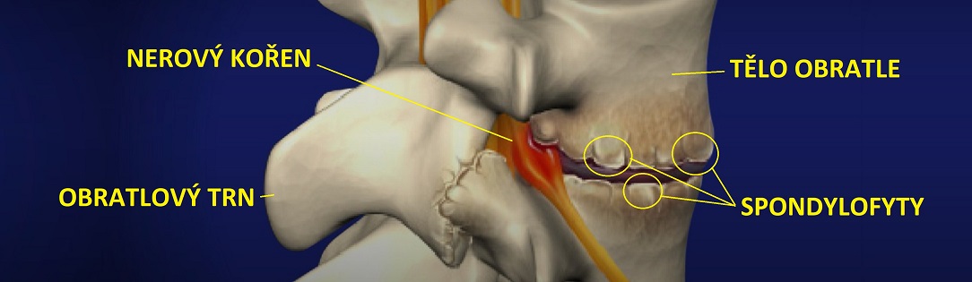 CERVICAL_SPONDYLOSIS_CZ1084X315