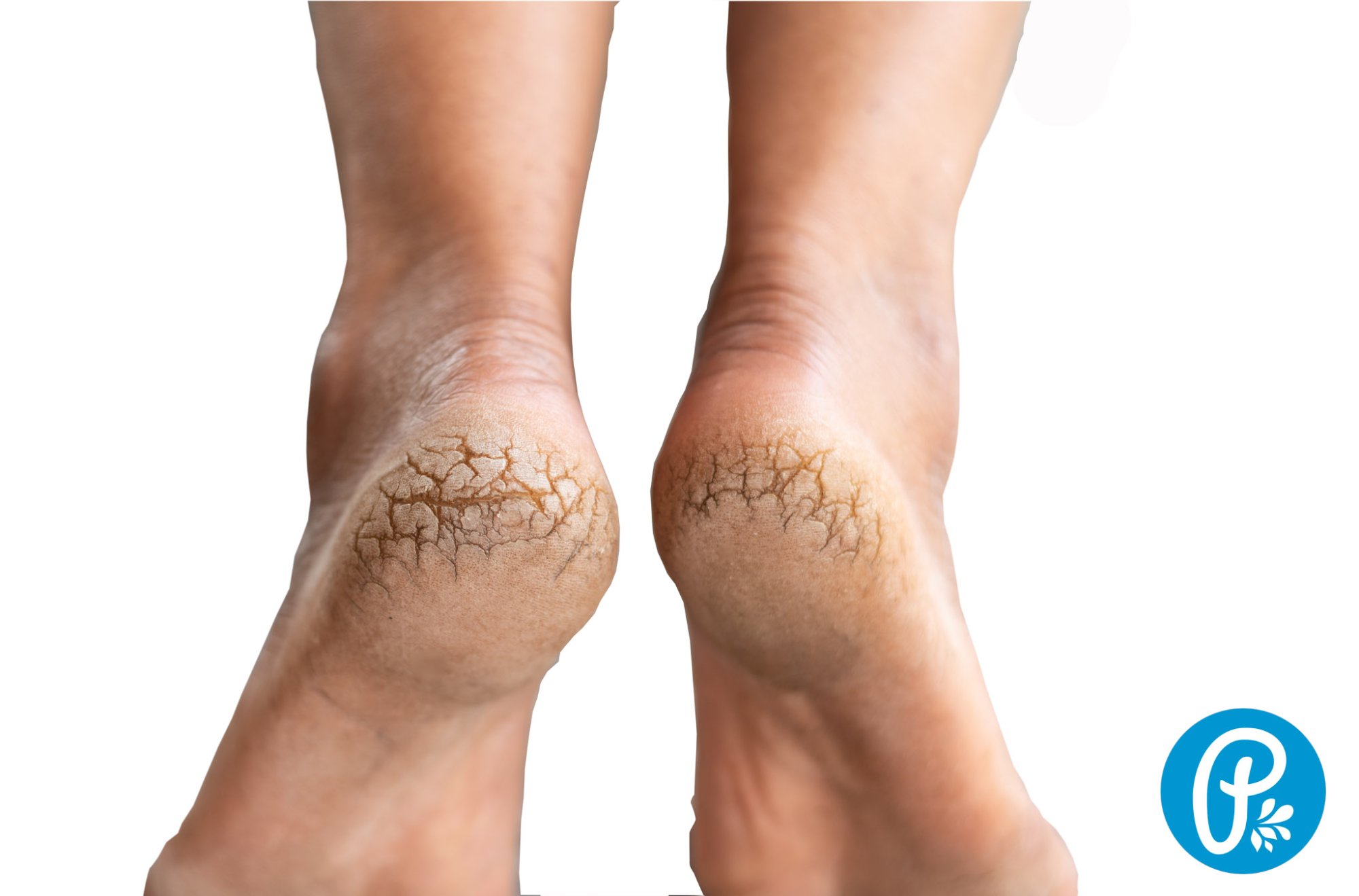 Popraskané paty vyřeší přírodní řešení