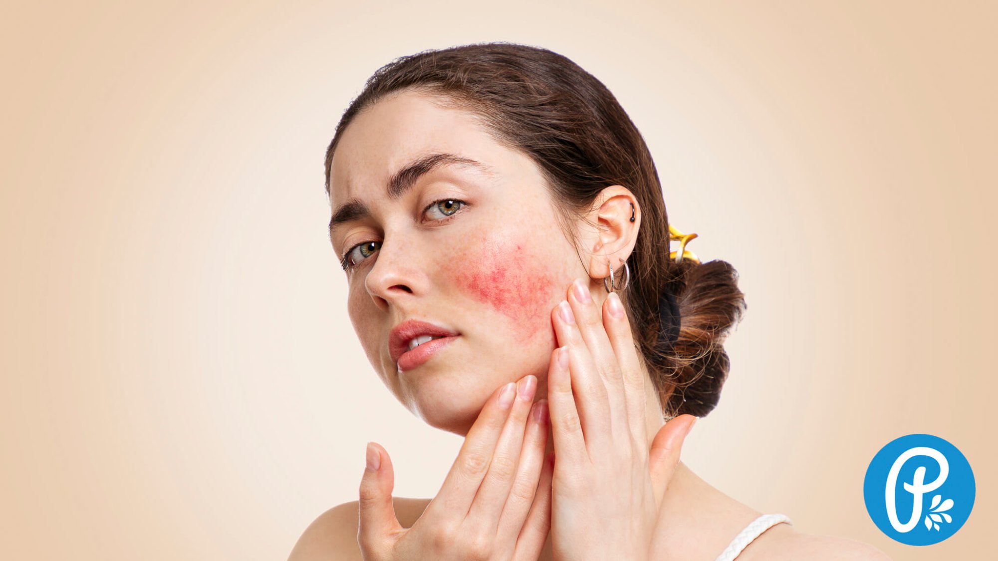 Růžovka aneb Rosacea: Příčiny, léčba a přírodní léčba