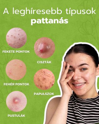 Ó, PATTANÁSOK!. 😩 A pattanások időről időre szinte minden nőt sújtanak. 😬 A lényeg, hogy felismerd, milyen típusú...