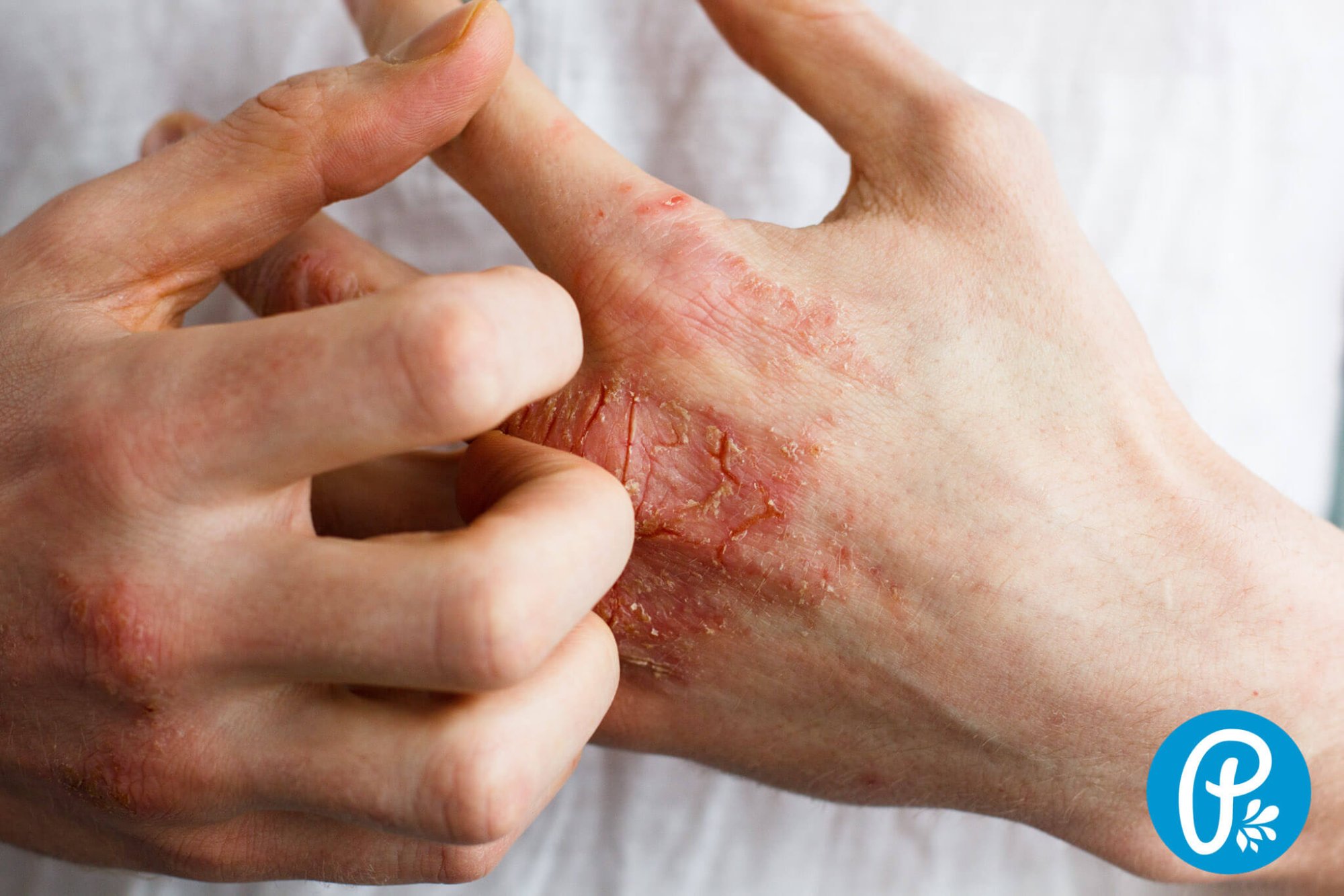 Eczema - cum să o îngrijim?