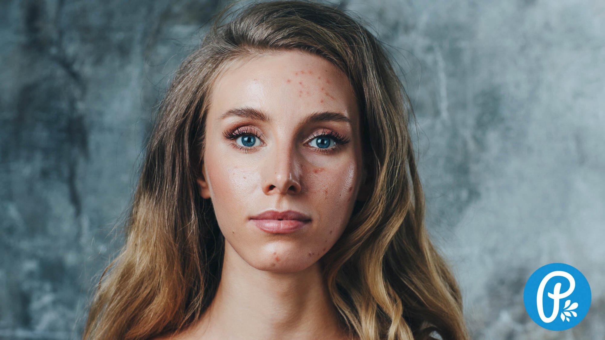 Akné: príčiny a ako sa ho zbaviť