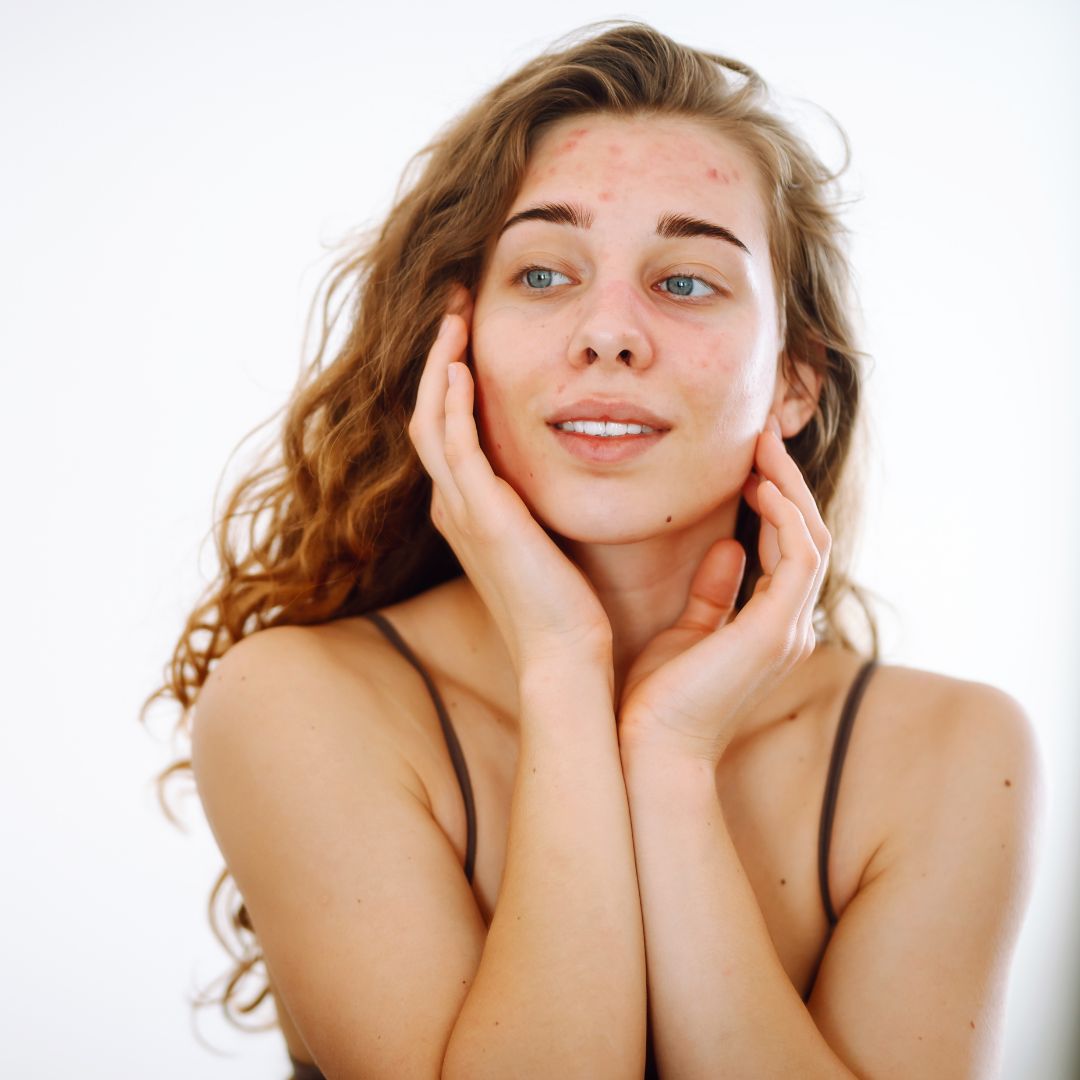 Máte zmiešanú pleť? Toto musíte vedieť o jej starostlivosti