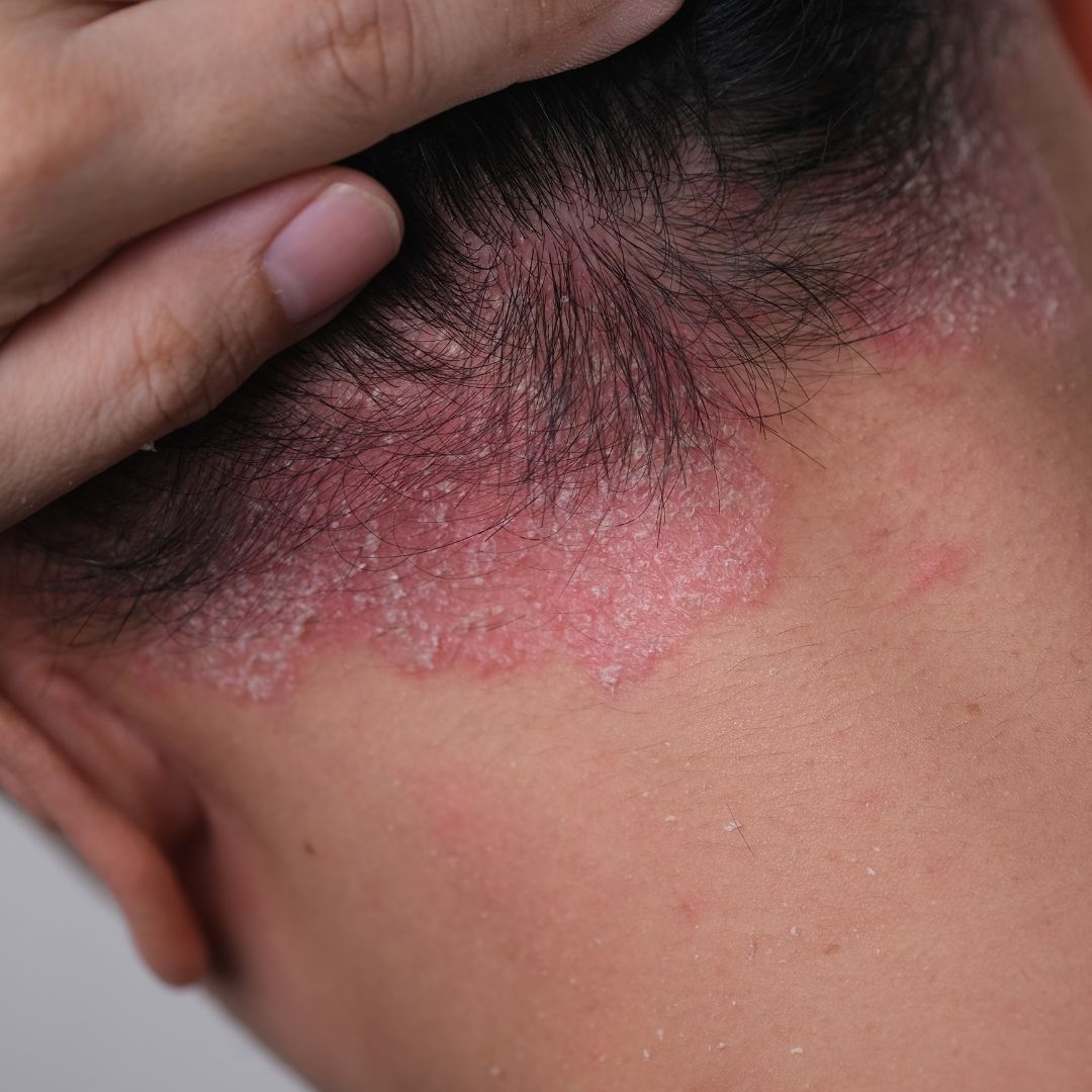 Psoriáza - čo to je a dá sa zvládnuť prirodzene?