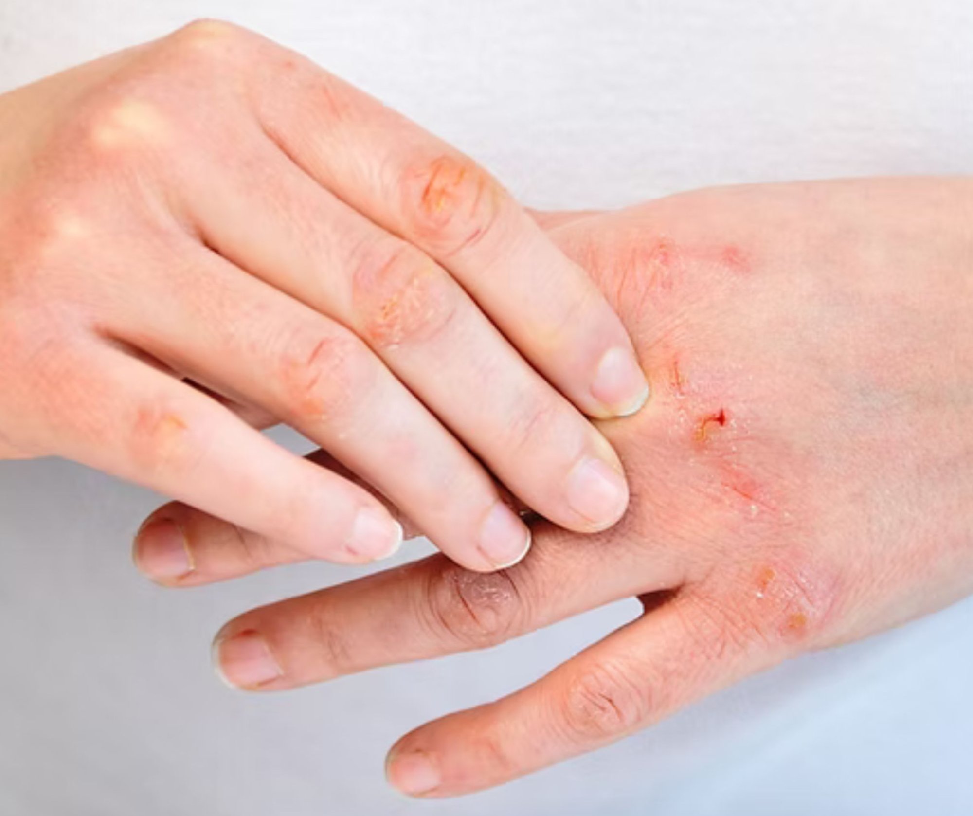 Zastavte bolesť: Ako vyliečiť suché popraskané ruky a vrátiť im hebkosť za 7 dní