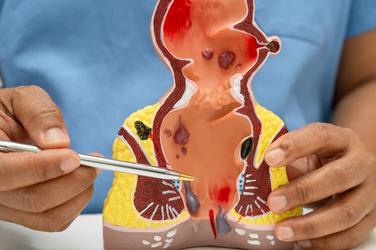 Știați că hemoroizii pot recidiva după o intervenție chirurgicală la până la 50% dintre pacienți?