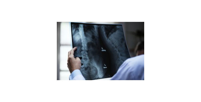 Aneurysmata představují nebezpečné vychlípeniny