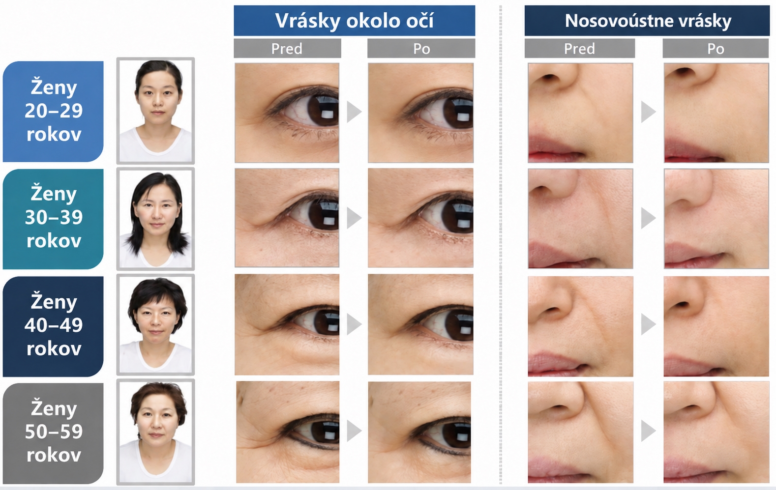 Vrásky okolo očí a nosoústne vrásky pred a po jednom použití liftingovej masky PEPPLUS+