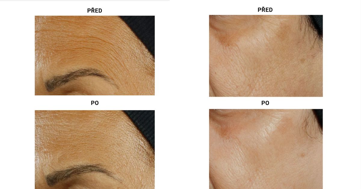 Perricone MD Triple Retinol před a po