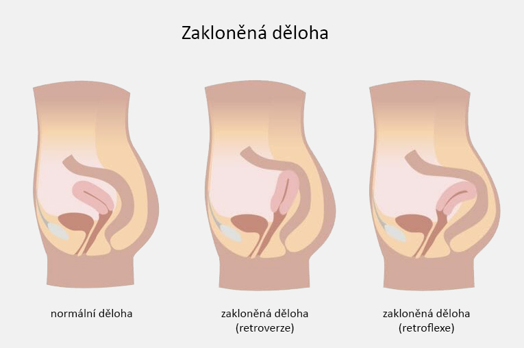 Co je to zakloněná (obrácená) děloha?