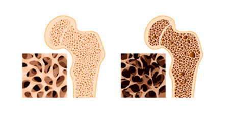 Yerba Maté jako podpůrný prostředek proti řidnutí kostí - osteoporóze?