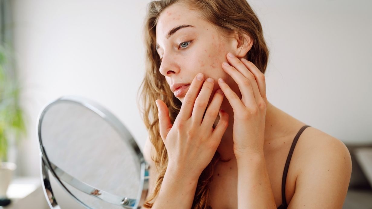 Zapomeňte na krémy – skutečná příčina akné a ekzému se skrývá ve vaší krvi