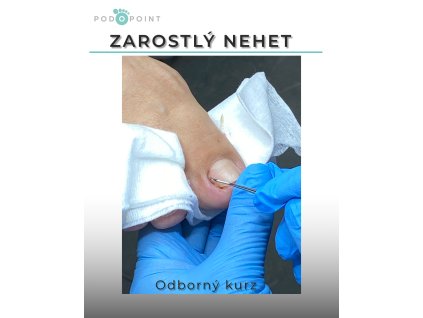 zarostlý nehet