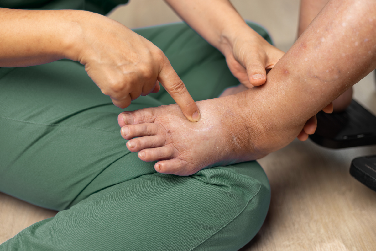 Diabetická noha a polyneuropatie. Komplikace cukrovky, které nepodceňujte