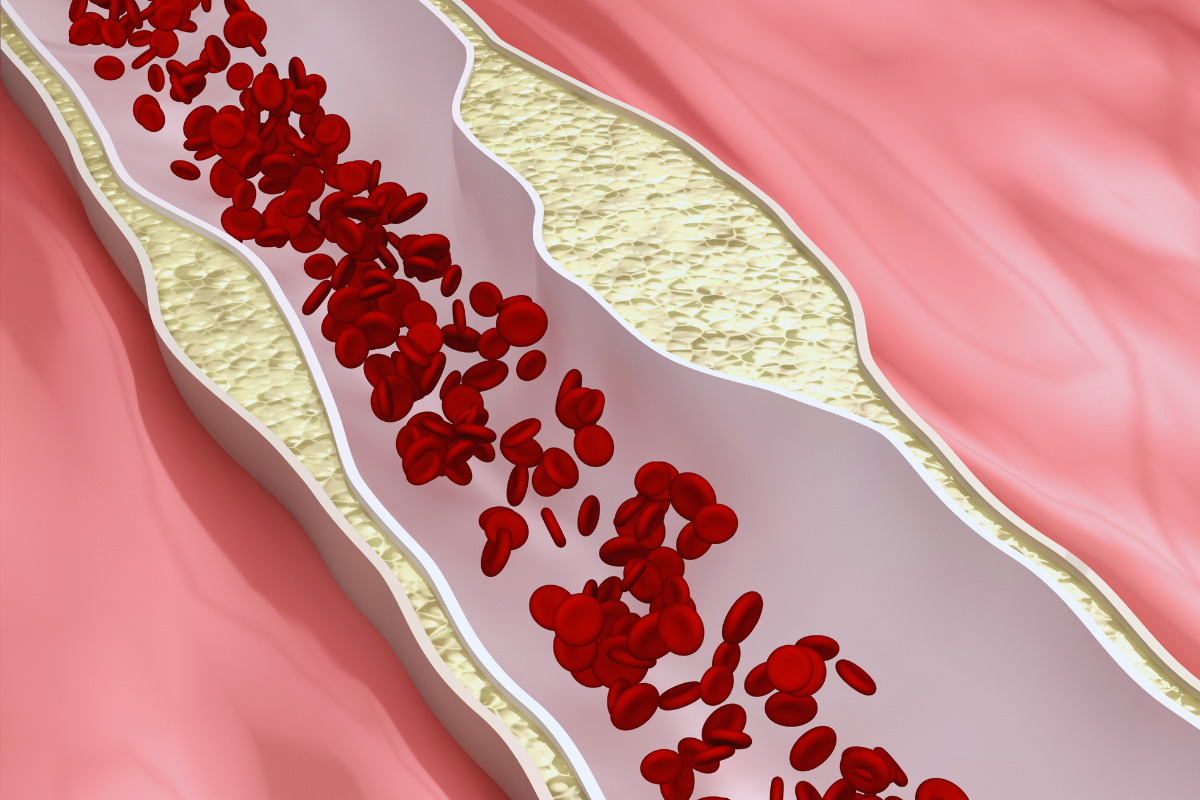 Nejčastější příčinou úmrtí Čechů je ateroskleróza, jako následek dlouhodobě špatného stavu arteriálních cév.