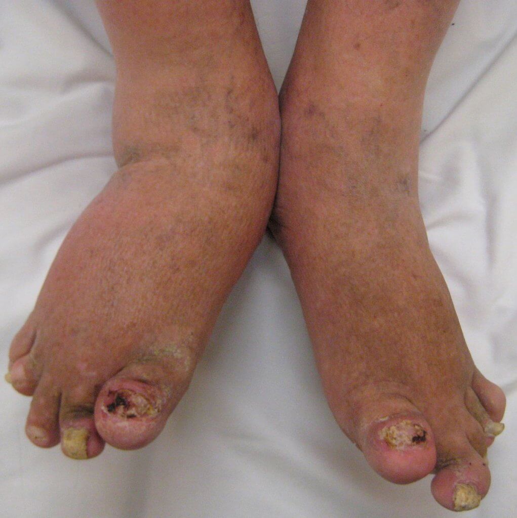 1200px-psoriatic-arthritis2010-1021x1024