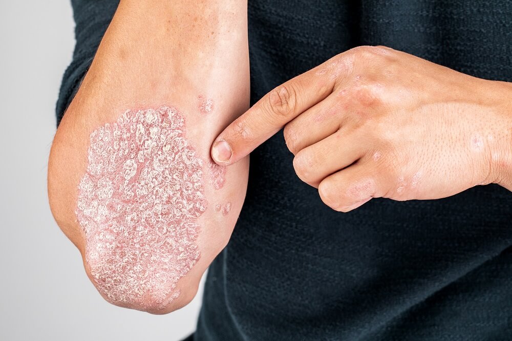 psoriaza-2