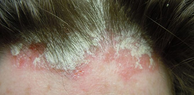 psoriaza-vo-vlasoch-hillvital-prirodne-produkty-670x329-1