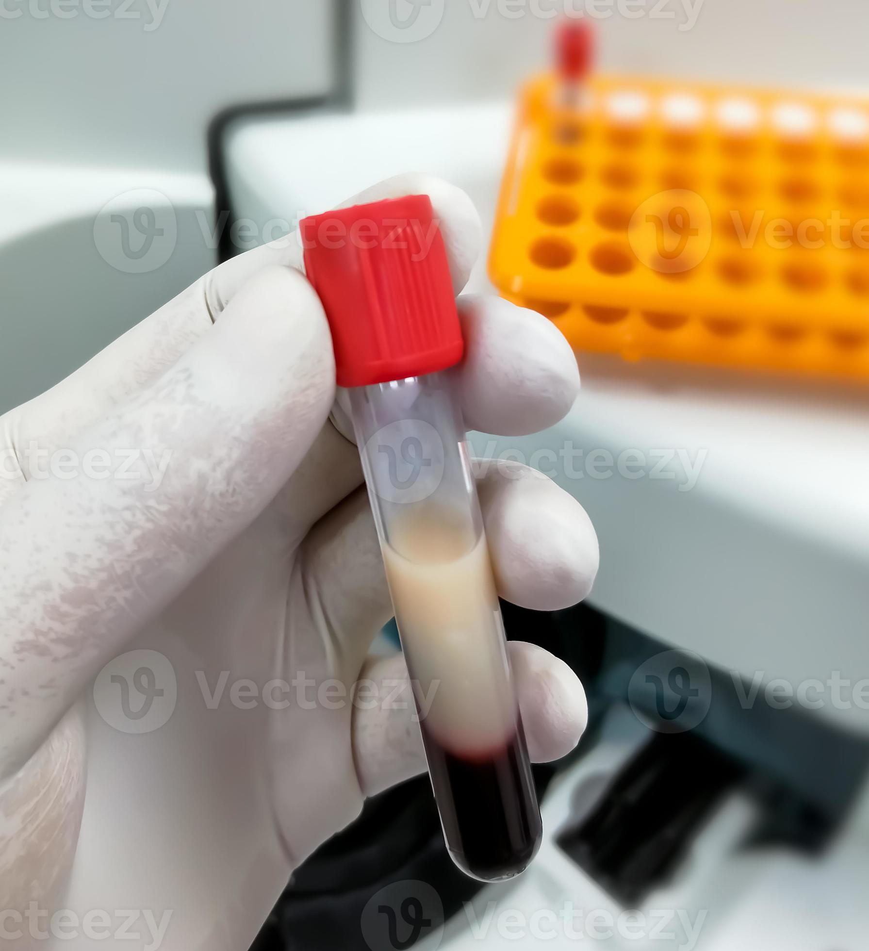 scientist-or-biochemist-hold-test-tube-with-lipemic-blood-sample-high-triglyceride-contain-blood-sample-lipid-profile-photo