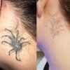 Pico second laser PX L9 tattoo removal