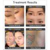 Pico second laser LS 10 treatment