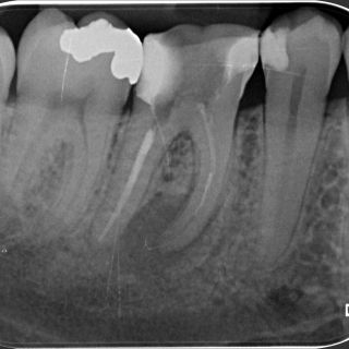 U delegovaného pacienta s 46 jsme řešili komplikaci po zalomeném nástroji v ML kanálku. 🦷 Nástroj se podařilo odstranit,...