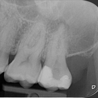 Pacient se zubem 27 byl odeslán od PZL kvůli úzkým a esovitě zakřiveným kořenovým kanálkům – výzva pro každý nástroj i pro...