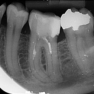 Pacient se zubem 36 byl odeslán od PZL kvůli obtížně odstranitelnému cementu a výraznému zakřivení meziálního kořene. 🦷...