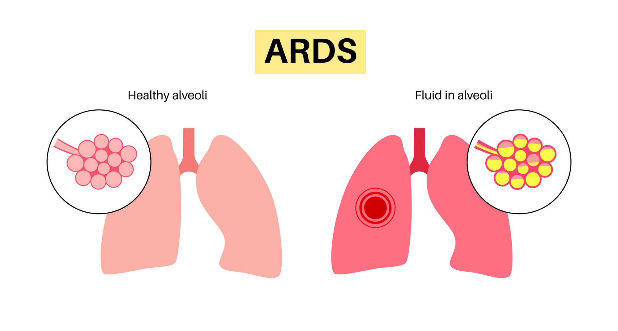 Akutní respirační syndrom (ARDS): Když plíce potřebují intenzivní podporu