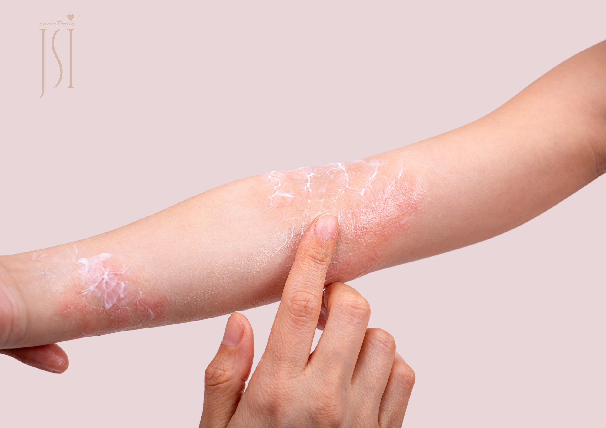 Co je ekzém a jak k němu přistupovat