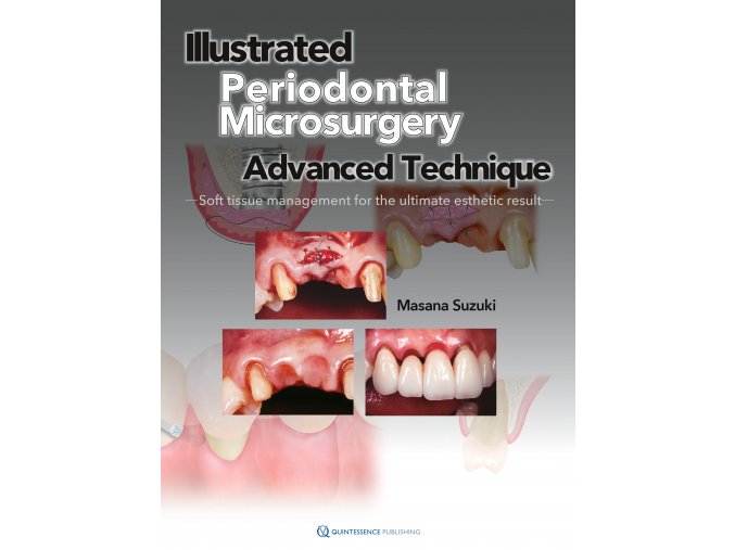 22741 cover suzuki the illustrated advanced technique of periodontal microsurgery