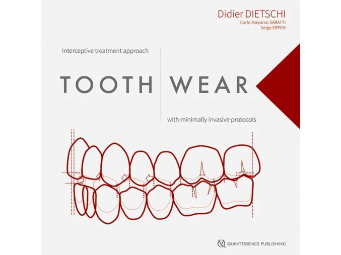 Tooth wear