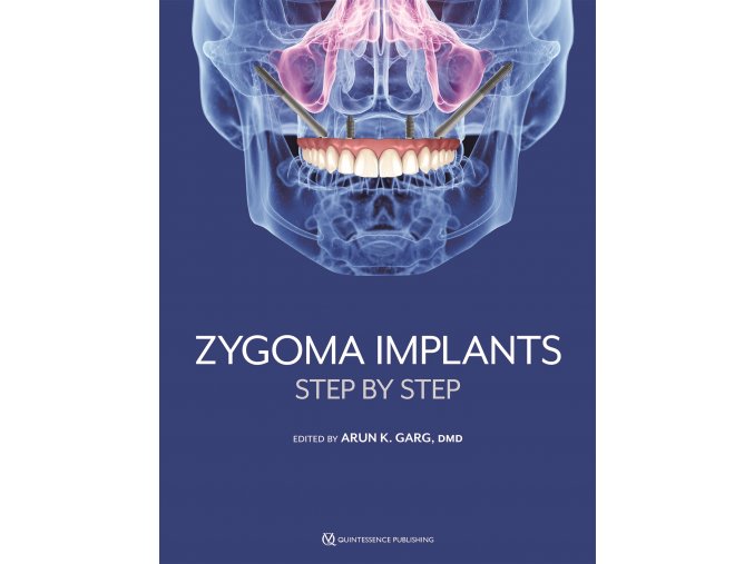 20921 cover garg zygoma implants