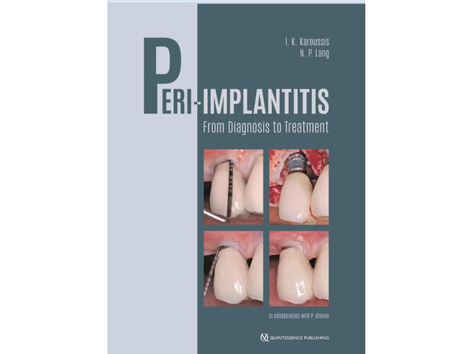Peri-Implantitis