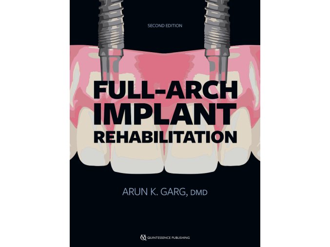 Full-Arch Implant Rehabilitation