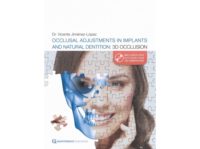 Occlusal Adjustments in Implants