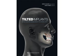 22841 Cover Agliardi Tilted Implants