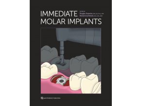 24111 cover deporter immediate molar implants