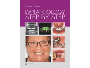 Implantology Step by Step