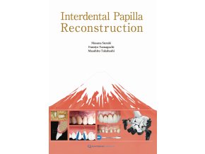 Interdental Papilla Reconstruction