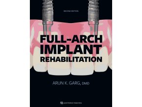 Full-Arch Implant Rehabilitation