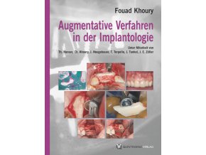 Augmentative Verfahren in der Implantologie