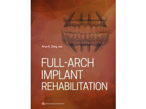 Full-Arch Implant Rehabilitation