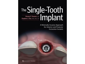 22831 Cover Tarnow Single Tooth Implant