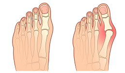 Ako na zmiernenie príznakov a bolesti vbočeného palca- Hallux Valgus