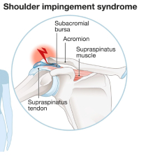 Impingement syndrom