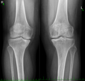 Rozdíl mezi osteoartrózou a revmatoidní artritidou