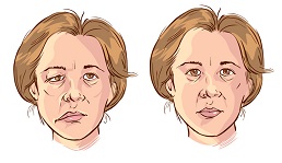 Paréza lícního nervu